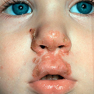 انواع بیماری های پوستی در کودکان