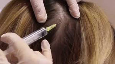 مزوتراپی از راه های درمان و تقویت مو