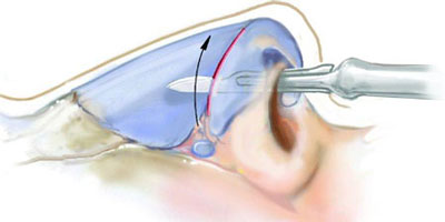 جراحی بسته بینی