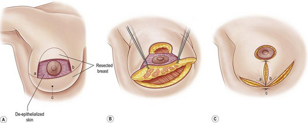 جراحی زیبایی سینه