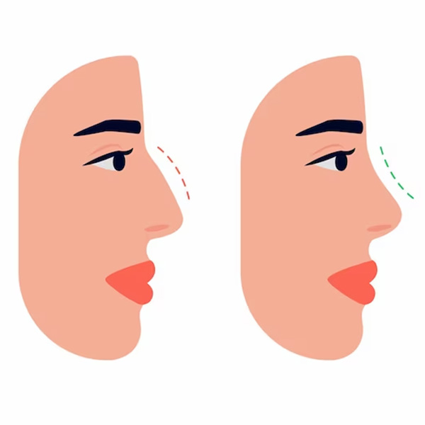 پوست بینی تاثیری بر جراحی دارد؟