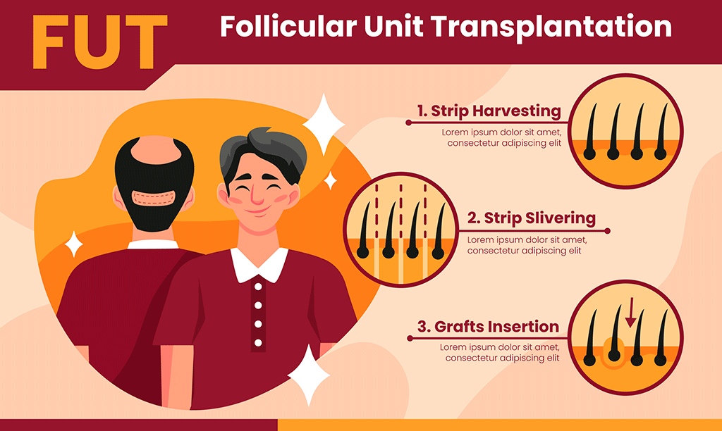 کاشت مو به روش FUT در کلینیک تخصصی